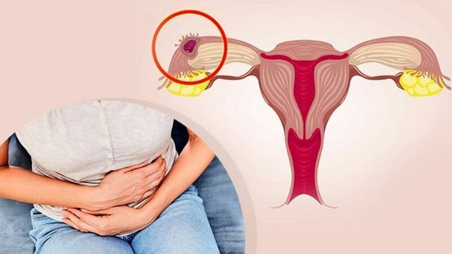 Người phụ nữ 42 tuổi suýt mất mạng do chủ quan khi bị đau bụng dưới âm ỉ, ra máu bất thường suốt 3 tuần - Ảnh 1.