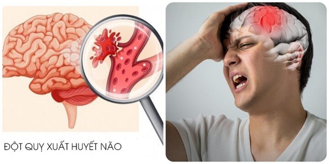 Bác sĩ cảnh báo: Trước 3 ngày nhồi máu não, 90% bệnh nhân đều làm 3 việc này, việc thứ hai bạn vẫn đang làm hàng ngày! - Ảnh 2.