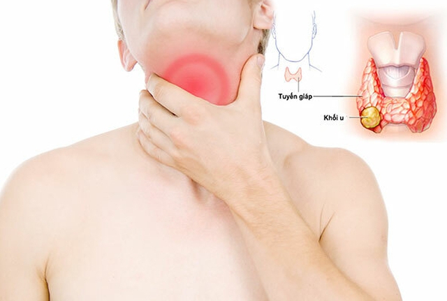 2 vợ chồng đang khỏe mạnh bất ngờ phát hiện ung thư tuyến giáp: Thừa nhận cùng có chung điểm này - Ảnh 4.