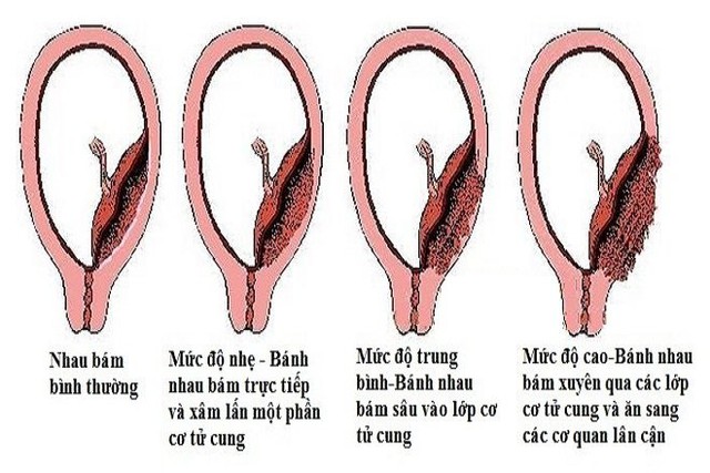 Thận trọng với nhau cài răng lược khi mang thai - Ảnh 2. Thận trọng với nhau cài răng lược khi mang thai - Ảnh 2.