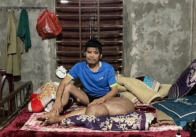 Người đ&agrave;n &ocirc;ng c&oacute; khối u khổng lồ đau x&oacute;t nh&igrave;n vợ con lay lắt v&igrave; bệnh tật - Ảnh 1.