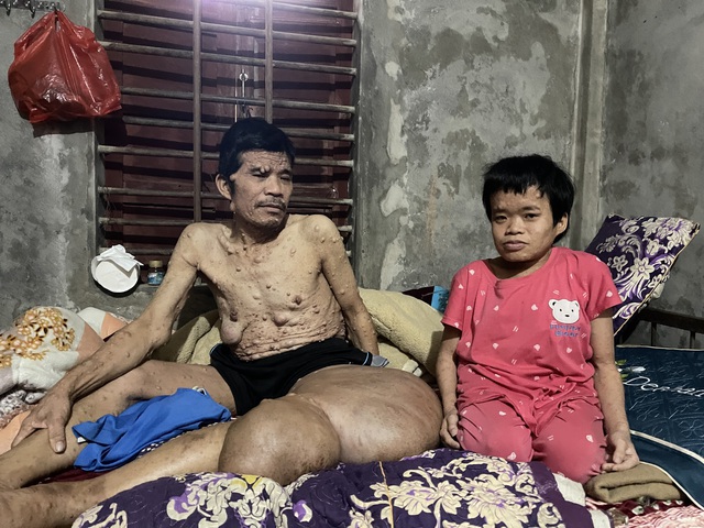 Người đ&agrave;n &ocirc;ng c&oacute; khối u khổng lồ đau x&oacute;t nh&igrave;n vợ con lay lắt v&igrave; bệnh tật - Ảnh 2.