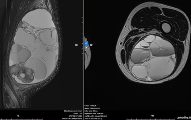 Người đ&agrave;n &ocirc;ng ph&aacute;t hiện ung thư &aacute;c t&iacute;nh hiếm gặp từ dấu hiệu bất thường ở ch&acirc;n - Ảnh 1.
