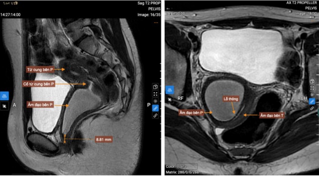 Rong kinh k&eacute;o d&agrave;i, b&eacute; g&aacute;i 13 tuổi ph&aacute;t hiện dị tật bẩm sinh hiếm gặp - Ảnh 1.