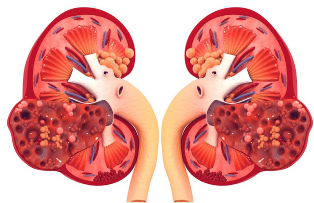 Món ăn rẻ tiền quen thuộc trong bữa cơm Việt, nhưng người bệnh suy thận được khuyến cáo không nên ăn - Ảnh 1. Món ăn rẻ tiền quen thuộc trong bữa cơm Việt, nhưng người bệnh suy thận được khuyến cáo không nên ăn - Ảnh 1.