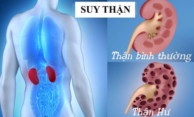 Suy thận không tự nhiên mà có: 6 bệnh đang âm thầm phá hủy chức năng thận của bạn - Ảnh 1. Suy thận không tự nhiên mà có: 6 bệnh đang âm thầm phá hủy chức năng thận của bạn - Ảnh 1.