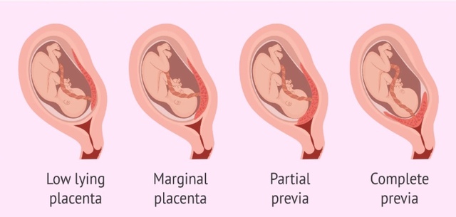 Bé trai 3,7kg chào đời an toàn sau ca mổ cấp cứu 'nghẹt thở' của các bác sĩ Bệnh viện 19-8 - Ảnh 1. Bé trai 3,7kg chào đời an toàn sau ca mổ cấp cứu 'nghẹt thở' của các bác sĩ Bệnh viện 19-8 - Ảnh 1.