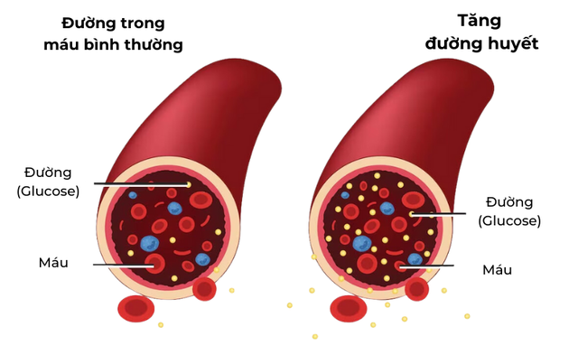 Sau tuổi 50: 3 dấu hiệu cảnh b&aacute;o đường huyết tăng v&agrave; 4 nguy&ecirc;n tắc kiểm so&aacute;t kh&ocirc;ng n&ecirc;n bỏ qua - Ảnh 1.