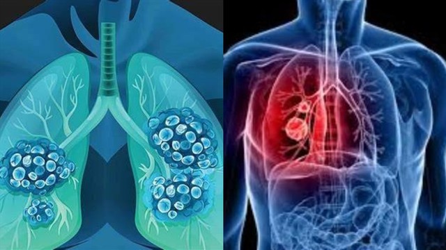 Người đàn ông 68 tuổi phát hiện ung thư phổi di căn từ những dấu hiệu người Việt dễ bỏ qua - Ảnh 1.