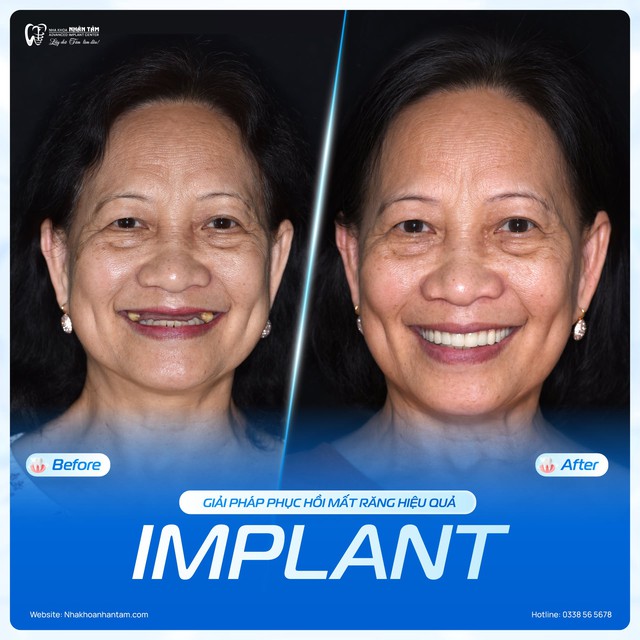 Quy tr&igrave;nh cấy gh&eacute;p Implant chuẩn y khoa: N&acirc;ng tầm trải nghiệm, an t&acirc;m phục hồi nụ cười - Ảnh 2.