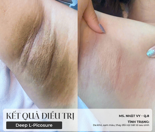 5 c&aacute;ch trị th&acirc;m n&aacute;ch hiệu quả, giảm sần s&ugrave;i cho da s&aacute;ng mịn tự tin - Ảnh 3.