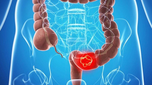 Người đàn ông 45 tuổi phát hiện tổn thương đại tràng nghi ung thư từ dấu hiệu nhiều người Việt bỏ qua - Ảnh 1.