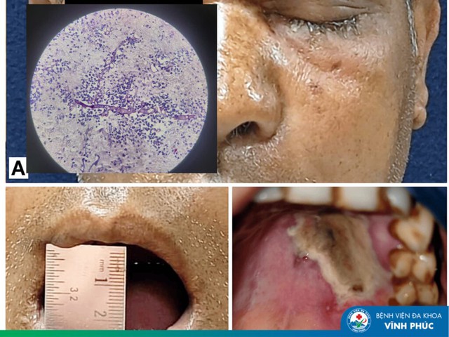 nấm đen - Ảnh 1.