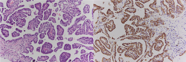 Người đ&agrave;n &ocirc;ng 67 tuổi ph&aacute;t hiện ung thư phổi từ dấu hiệu nhiều người Việt mắc phải - Ảnh 1.