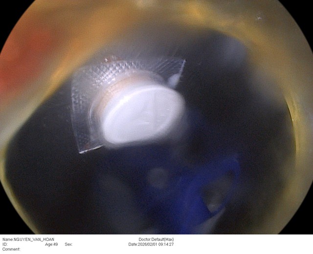 Uống thuốc giảm đau vai g&aacute;y, người đ&agrave;n &ocirc;ng nhập viện gấp v&igrave; một sai s&oacute;t nhiều người Việt mắc phải - Ảnh 1.