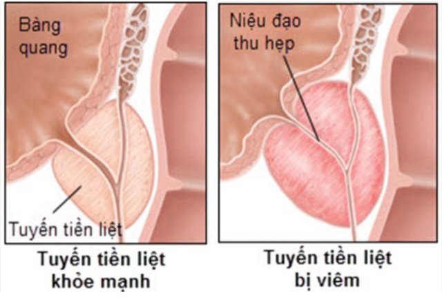 Người đ&agrave;n &ocirc;ng nhập viện v&igrave; tuyến tiền liệt to gấp 4 lần: B&aacute;c sĩ cảnh b&aacute;o dấu hiệu dễ bị bỏ qua - Ảnh 2.