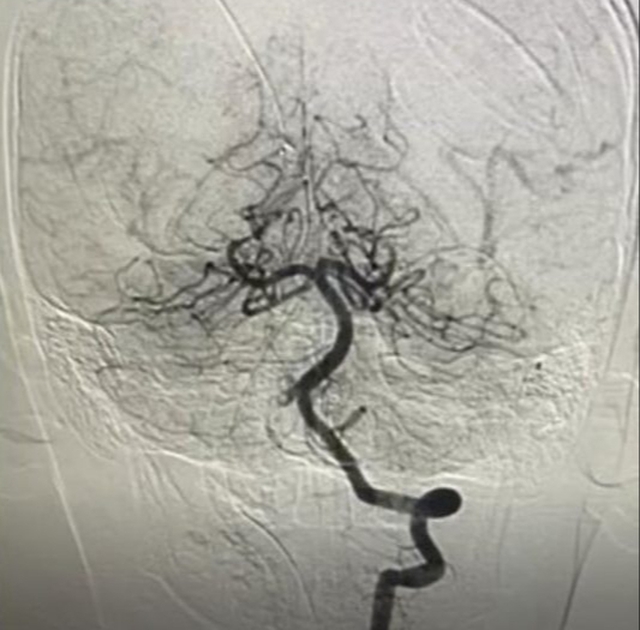 B&eacute; trai 10 tuổi đột quỵ sau khi chơi cầu l&ocirc;ng, b&aacute;c sĩ cảnh b&aacute;o dấu hiệu dễ bị bỏ qua ở trẻ  - Ảnh 1.