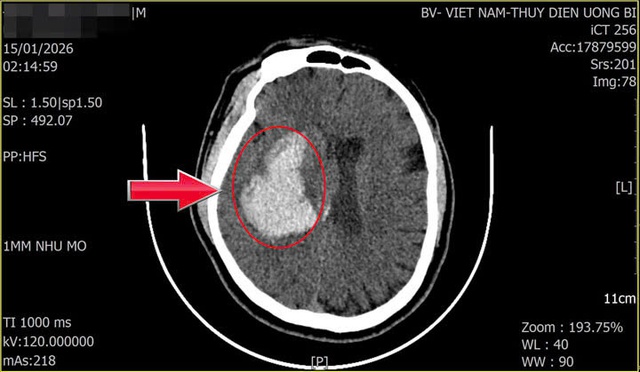 Người đ&agrave;n &ocirc;ng 44 tuổi đang khỏe mạnh bất ngờ đột quỵ từ dấu hiệu nhiều người Việt mắc phải - Ảnh 2.