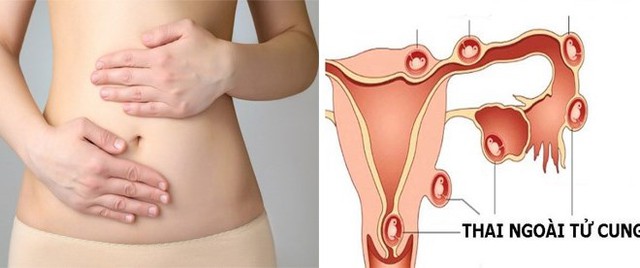 Thai ngo&agrave;i tử cung: Người phụ nữ 23 tuổi ph&aacute;t hiện muộn, su&yacute;t gặp biến chứng nguy hiểm - Ảnh 2.