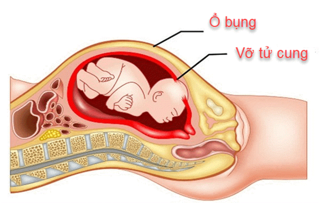 Sản phụ 29 tuổi vỡ tử cung trong đêm thừa nhận 1 sai lầm nhiều phụ nữ Việt mắc phải - Ảnh 1. Sản phụ 29 tuổi vỡ tử cung trong đêm thừa nhận 1 sai lầm nhiều phụ nữ Việt mắc phải - Ảnh 1.
