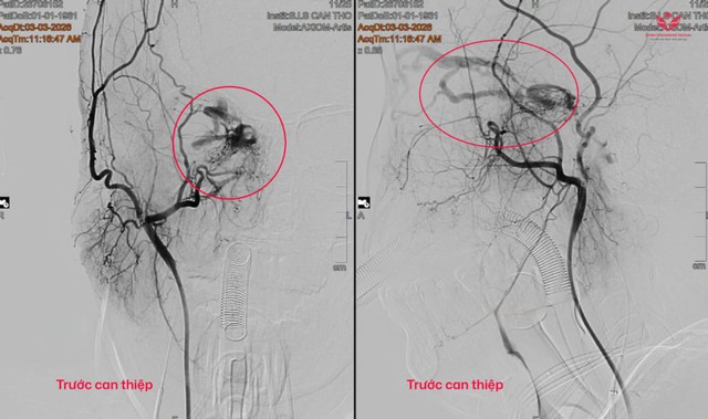 Người phụ nữ 65 tuổi phát hiện dị dạng mạch máu não từ dấu hiệu đỏ mắt, nhiều người Việt bỏ qua - Ảnh 1. Người phụ nữ 65 tuổi phát hiện dị dạng mạch máu não từ dấu hiệu đỏ mắt, nhiều người Việt bỏ qua - Ảnh 1.