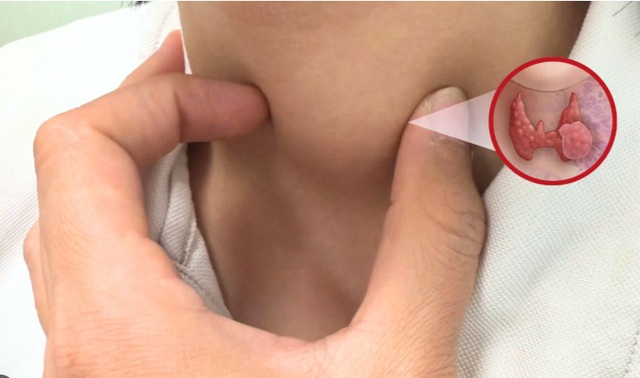 Người phụ nữ ph&aacute;t hiện ung thư tuyến gi&aacute;p từ dấu hiệu nhiều người Việt bỏ qua - Ảnh 3.