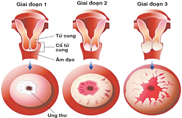 Người phụ nữ 25 tuổi phát hiện ung thư cổ tử cung sau khi sinh 2 con từ 1 việc nhiều người Việt bỏ qua - Ảnh 2. Người phụ nữ 25 tuổi phát hiện ung thư cổ tử cung sau khi sinh 2 con từ 1 việc nhiều người Việt bỏ qua - Ảnh 2.