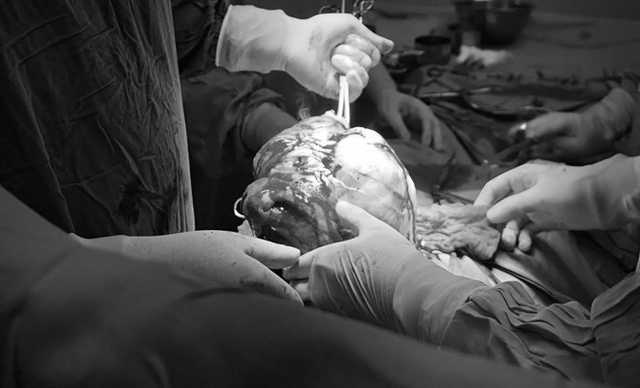 Người phụ nữ 28 tuổi ph&aacute;t hiện u xơ tử cung, nguy cơ cao g&acirc;y biến chứng từ 1 việc nhiều người Việt bỏ qua - Ảnh 1.