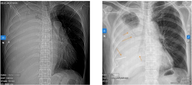 Người phụ nữ 66 tuổi nhập viện mới phát hiện ung thư phổi giai đoạn muộn từ dấu hiệu nhiều người Việt bỏ qua - Ảnh 1. Người phụ nữ 66 tuổi nhập viện mới phát hiện ung thư phổi giai đoạn muộn từ dấu hiệu nhiều người Việt bỏ qua - Ảnh 1.