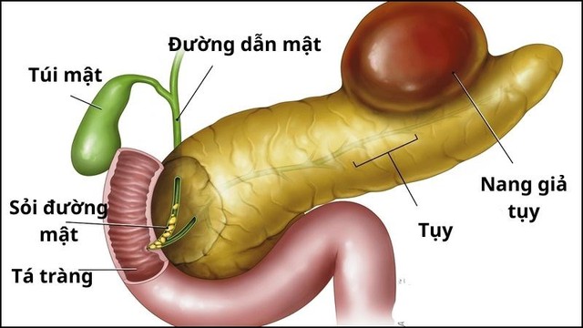 Người đàn ông 44 tuổi phát hiện viêm tụy cấp từ dấu hiệu nhiều người Việt mắc phải - Ảnh 2. Người đàn ông 44 tuổi phát hiện viêm tụy cấp từ dấu hiệu nhiều người Việt mắc phải - Ảnh 2.