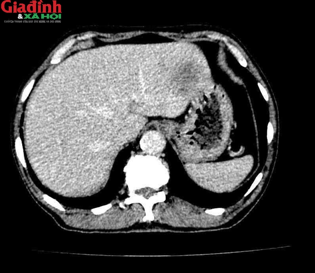 Đi ngo&agrave;i ph&acirc;n đen cảnh b&aacute;o ung thư đại tr&agrave;ng di căn gan: Dấu hiệu dễ bị bỏ qua - Ảnh 1.