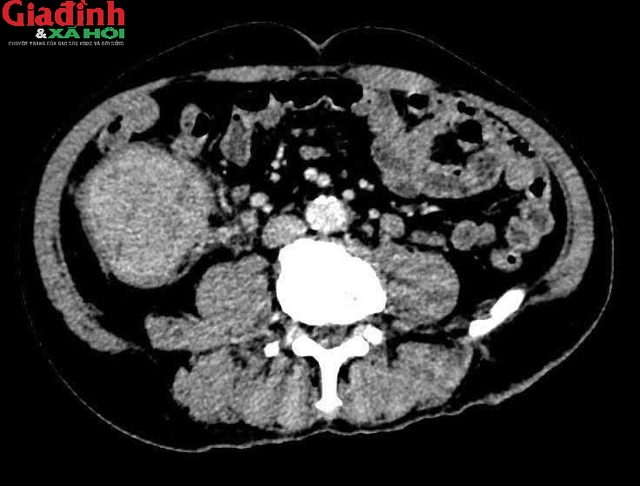 Đi ngo&agrave;i ph&acirc;n đen cảnh b&aacute;o ung thư đại tr&agrave;ng di căn gan: Dấu hiệu dễ bị bỏ qua - Ảnh 2.