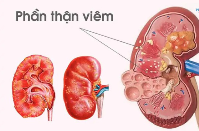 B&eacute; g&aacute;i 11 tuổi co giật, tăng huyết &aacute;p sau vi&ecirc;m họng do biến chứng vi&ecirc;m cầu thận hậu nhiễm li&ecirc;n cầu - Ảnh 1.