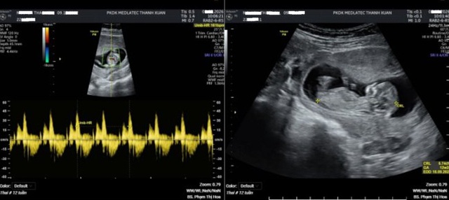 Thai phụ 24 tuổi nguy cơ tiền sản giật d&ugrave; kh&ocirc;ng triệu chứng, b&aacute;c sĩ cảnh b&aacute;o việc nhiều người Việt bỏ qua - Ảnh 1.