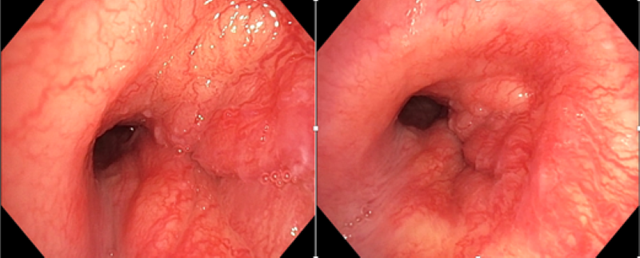 Người đ&agrave;n &ocirc;ng 32 tuổi ph&aacute;t hiệu ung thư đường thở hiếm gặp từ dấu hiệu nhiều người Việt mắc phải - Ảnh 1.