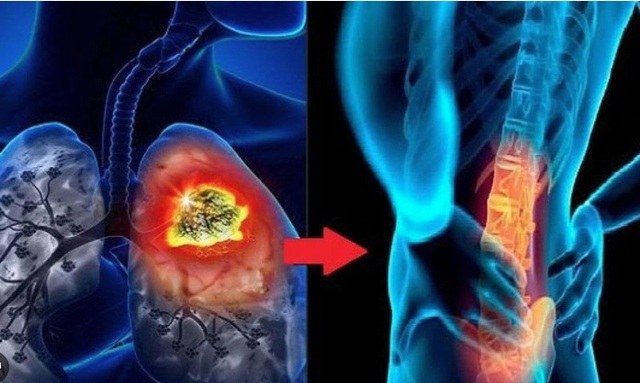 Người đ&agrave;n &ocirc;ng 60 tuổi ph&aacute;t hiện ung thư phổi giai đoạn 4 di căn n&atilde;o từ dấu hiệu nhiều người Việt mắc phải - Ảnh 2.