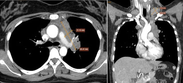 C&ocirc; g&aacute;i 25 tuổi ph&aacute;t hiện mắc ung thư hạch từ dấu hiệu tưởng v&ocirc; hại, nhiều người Việt bỏ qua - Ảnh 2.