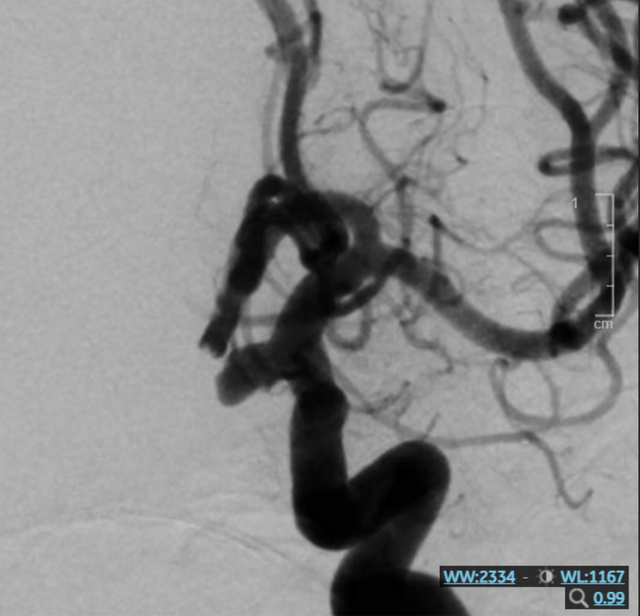Người phụ nữ 52 tuổi tình cờ phát hiện nguy cơ đột quỵ từ dấu hiệu nhiều người Việt bỏ qua - Ảnh 2. Người phụ nữ 52 tuổi tình cờ phát hiện nguy cơ đột quỵ từ dấu hiệu nhiều người Việt bỏ qua - Ảnh 2.