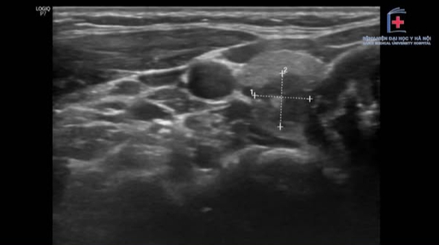 Chủ quan với nhân tuyến giáp, người phụ nữ trẻ đi khám phát hiện di căn 13 hạch - Ảnh 1. Chủ quan với nhân tuyến giáp, người phụ nữ trẻ đi khám phát hiện di căn 13 hạch - Ảnh 1.