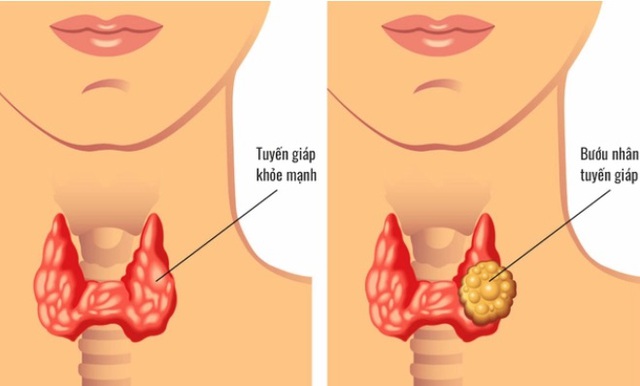 Chủ quan với nhân tuyến giáp, người phụ nữ trẻ đi khám phát hiện di căn 13 hạch - Ảnh 2. Chủ quan với nhân tuyến giáp, người phụ nữ trẻ đi khám phát hiện di căn 13 hạch - Ảnh 2.
