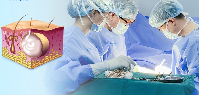 U bã đậu 10 năm bất ngờ hóa ung thư ở người đàn ông 40 tuổi, dấu hiệu cảnh báo nhiều người bỏ qua - Ảnh 1. U bã đậu 10 năm bất ngờ hóa ung thư ở người đàn ông 40 tuổi, dấu hiệu cảnh báo nhiều người bỏ qua - Ảnh 1.