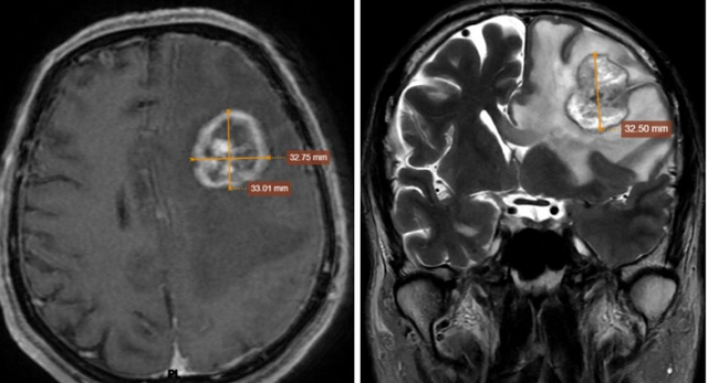 Người đ&agrave;n &ocirc;ng 67 tuổi ở H&agrave; Nội ph&aacute;t hiện ung thư phổi di căn từ dấu hiệu nhiều người Việt bỏ qua - Ảnh 1.