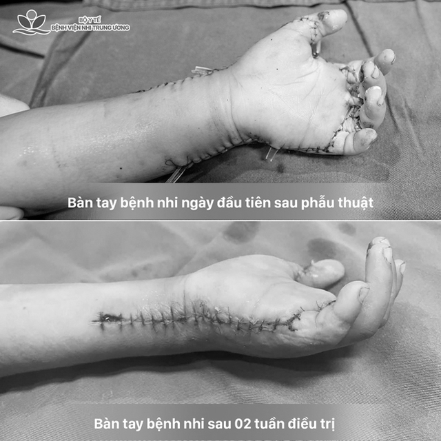 B&eacute; 7 tuổi su&yacute;t mất b&agrave;n tay v&igrave; m&aacute;y tự chế, hồi chu&ocirc;ng cảnh b&aacute;o trong nhiều gia đ&igrave;nh - Ảnh 1.
