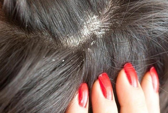 "Càng gội càng nhiều gàu:" Sự thật ngỡ ngàng đằng sau mái tóc lúc nào cũng ngứa - Ảnh 1. "Càng gội càng nhiều gàu:" Sự thật ngỡ ngàng đằng sau mái tóc lúc nào cũng ngứa - Ảnh 1.