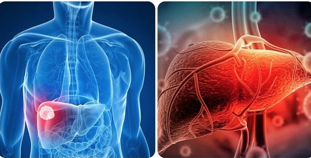 Người đ&agrave;n &ocirc;ng 40 tuổi mắc ung thư gan v&igrave; th&oacute;i quen nhiều người Việt đang l&agrave;m mỗi ng&agrave;y - Ảnh 1.