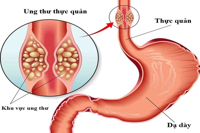Người đ&agrave;n &ocirc;ng đang khỏe mạnh ph&aacute;t hiện ung thư thực quản, thừa nhận 2 sai lầm nhiều nam giới Việt mắc phải - Ảnh 1.