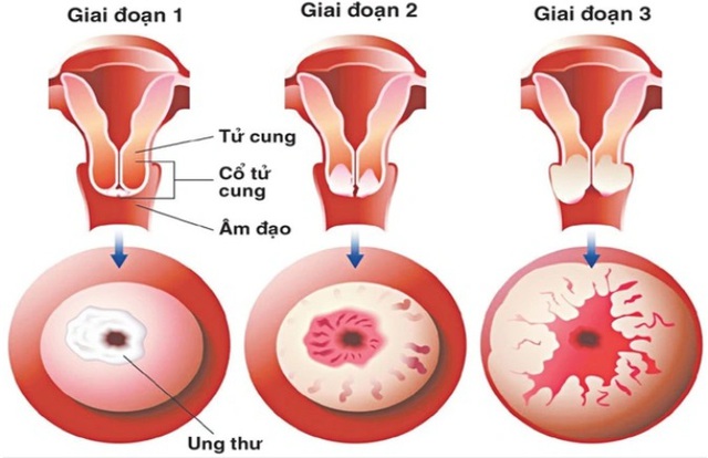 Người phụ nữ 37 tuổi bất ngờ ph&aacute;t hiện tiền ung thư cổ tử cung từ 1 việc nhiều chị em Việt bỏ qua - Ảnh 2.