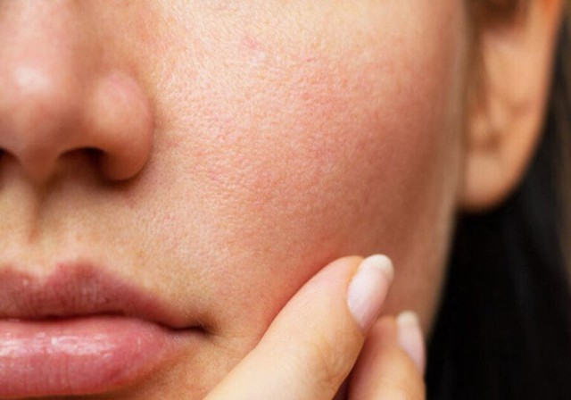 Da mặt bị đỏ rát: Làm ngay những điều này để "giải cứu" làn da kịp thời - Ảnh 1.