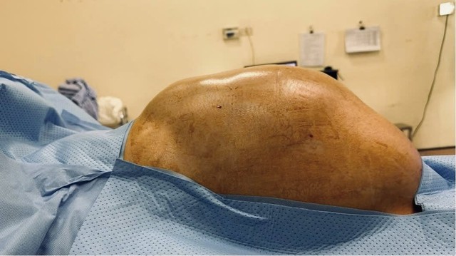 Thiếu nữ 16 tuổi mang khối u buồng trứng gần 15kg: Bác sĩ khuyến cáo không chủ quan với dấu hiệu bất thường - Ảnh 1.