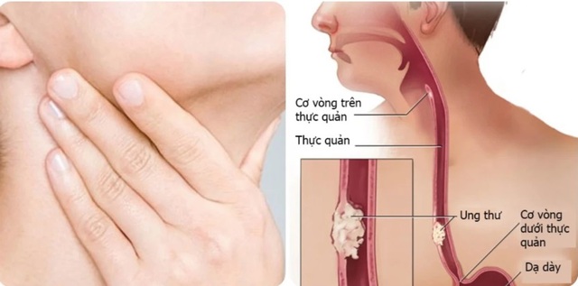 Người đ&agrave;n &ocirc;ng ph&aacute;t hiện mắc ung thư thực quản thừa nhận 2 sai lầm nhiều người Việt mắc phải - Ảnh 2.